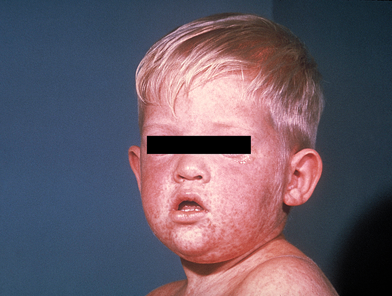 The number of confirmed measles cases rose this week to 359. Photo courtesy of CDC