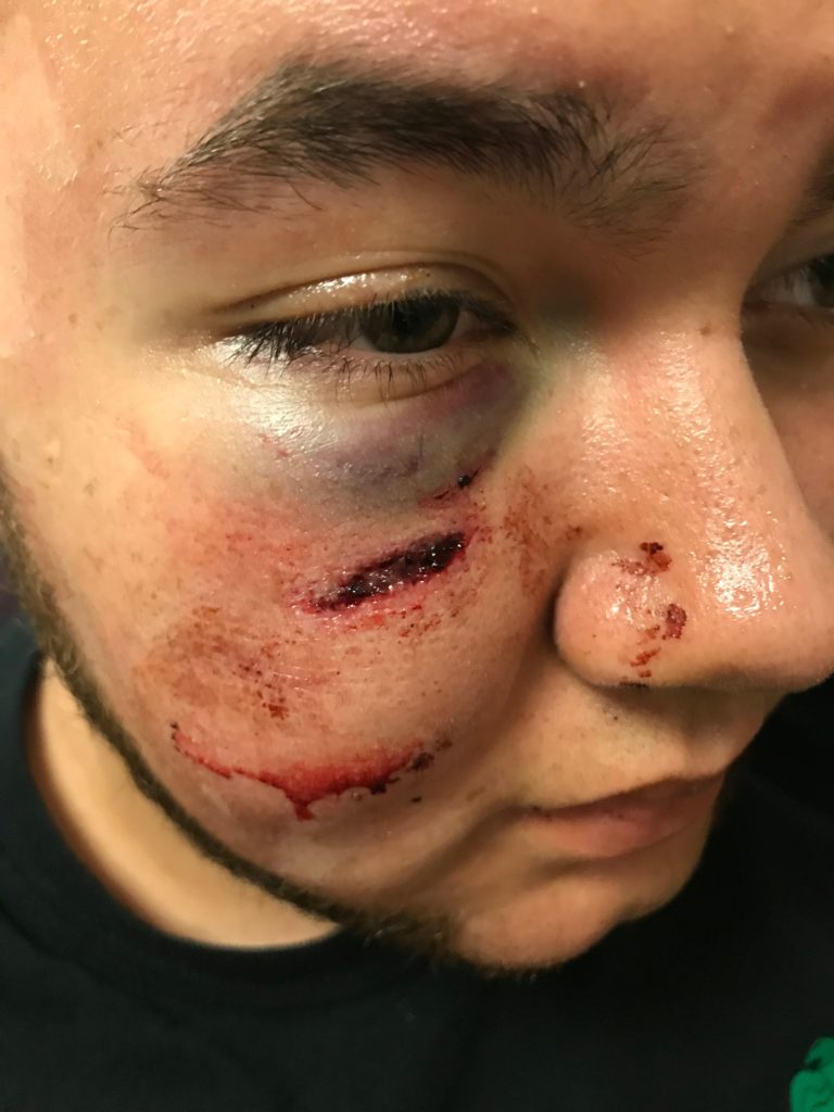 Ricardo Mendoza suffered injuries to the face during his arrest in 2018. Photo courtesy of Abraham Rubert-Schewel