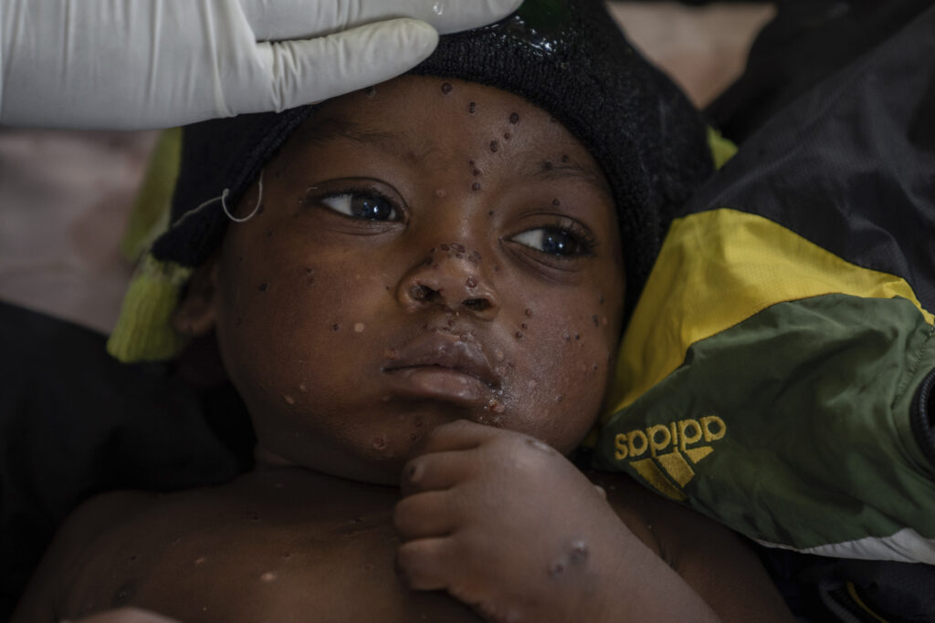 Emile Miango, 2, who has mpox, lies in the hospital, on Wednesday, Sept. 4, 2024, in Kamituga, South Kivu province, which is the epicenter of the world’s latest outbreak of the disease in eastern Congo. (AP Photo/Moses Sawasawa)