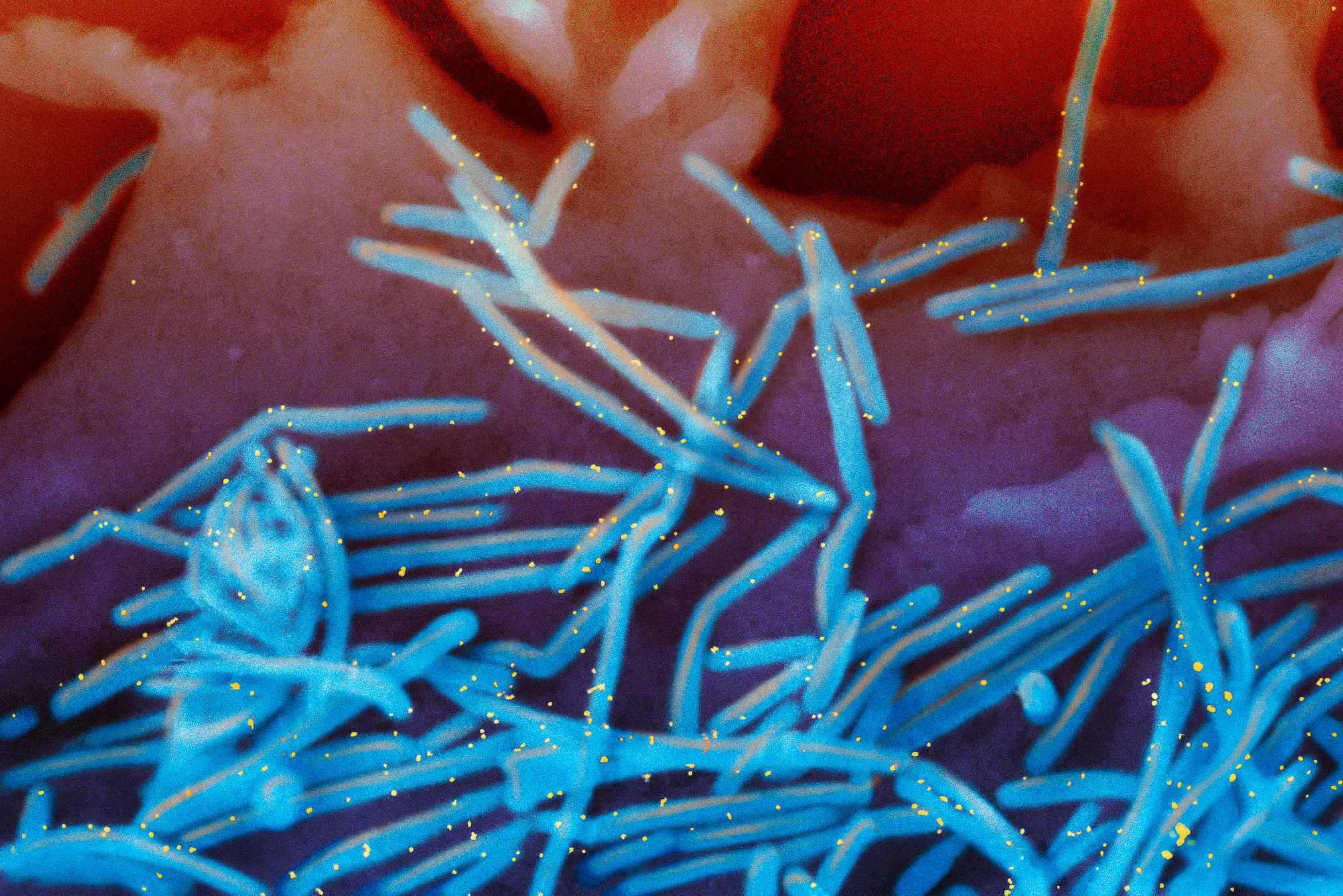 This electron microscope image provided by the National Institutes of Health shows human respiratory syncytial virus (RSV) virions, colorized blue, and anti-RSV F protein/gold antibodies, colorized yellow, shedding from the surface of human lung cells. National Institute of Allergy and Infectious Diseases, NIH via AP, File